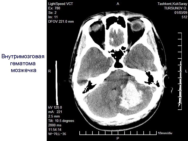 Внутримозговая гематома мозжечка 
