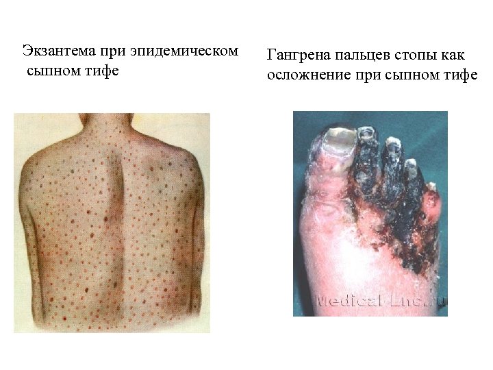 Экзантема при эпидемическом сыпном тифе Гангрена пальцев стопы как осложнение при сыпном тифе 