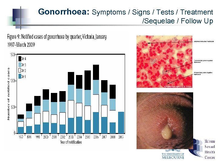Gonorrhoea: Symptoms / Signs / Tests / Treatment /Sequelae / Follow Up 