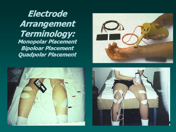 Electrode Arrangement Terminology: Monopolar Placement Bipoloar Placement Quadpolar Placement 