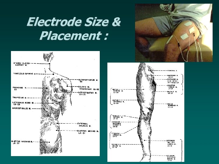 Electrode Size & Placement : 