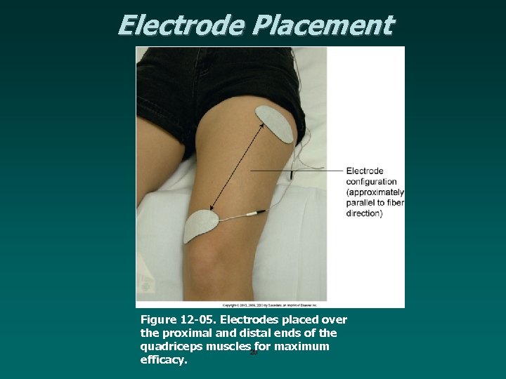 Electrode Placement Figure 12 -05. Electrodes placed over the proximal and distal ends of