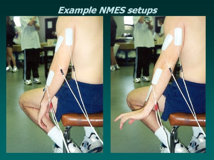 Example NMES setups 