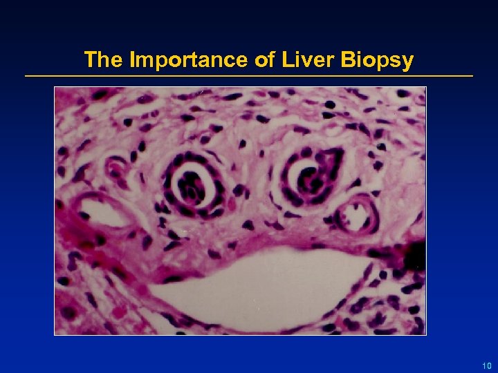 The Importance of Liver Biopsy 10 