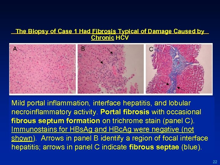 The Biopsy of Case 1 Had Fibrosis Typical of Damage Caused by Chronic HCV