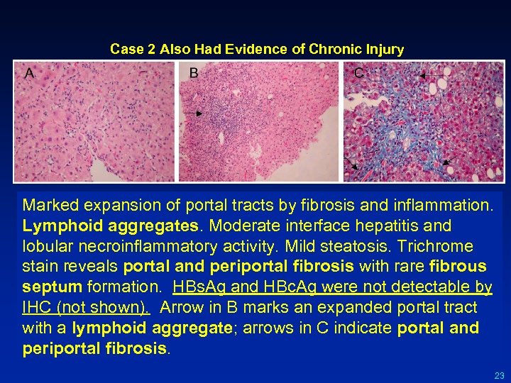 Case 2 Also Had Evidence of Chronic Injury Marked expansion of portal tracts by