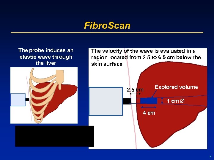 Fibro. Scan The probe induces an elastic wave through the liver The velocity of
