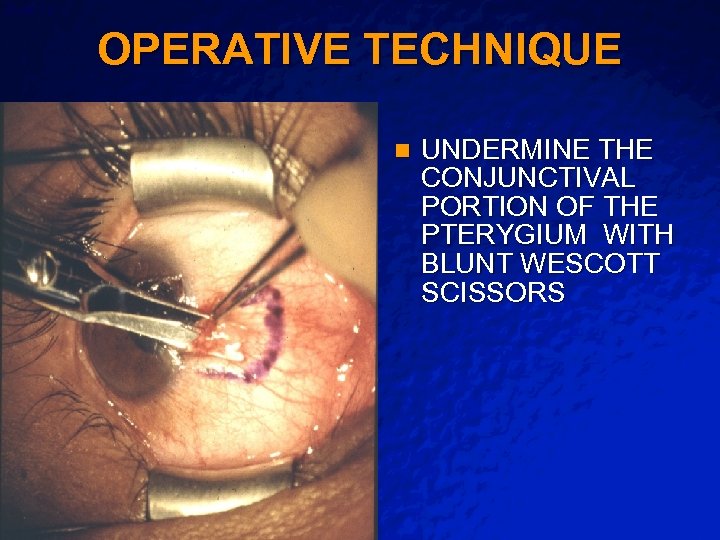 Slide 12 © 2003 By Default! OPERATIVE TECHNIQUE n A Free sample background from