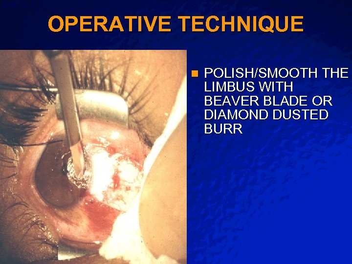 Slide 14 © 2003 By Default! OPERATIVE TECHNIQUE n A Free sample background from