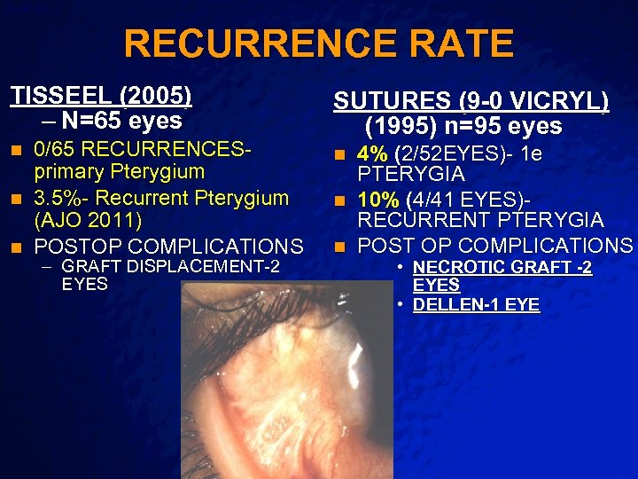 Slide 29 © 2003 By Default! RECURRENCE RATE TISSEEL (2005) – N=65 eyes 0/65
