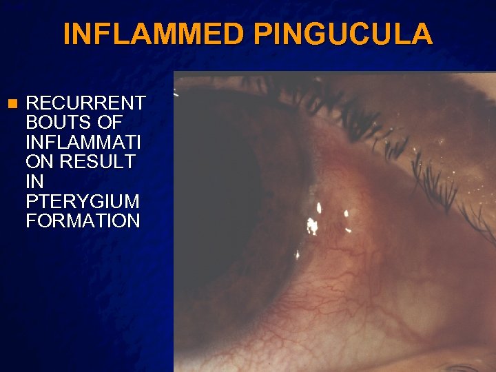 Slide 6 © 2003 By Default! INFLAMMED PINGUCULA n RECURRENT BOUTS OF INFLAMMATI ON
