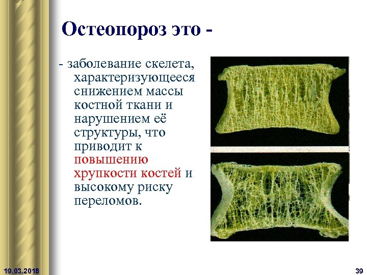 Остеопороз это - заболевание скелета, характеризующееся снижением массы костной ткани и нарушением её структуры,