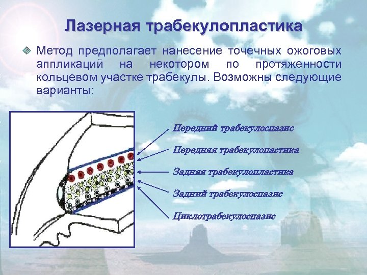 Лазерная трабекулопластика Метод предполагает нанесение точечных ожоговых аппликаций на некотором по протяженности кольцевом участке