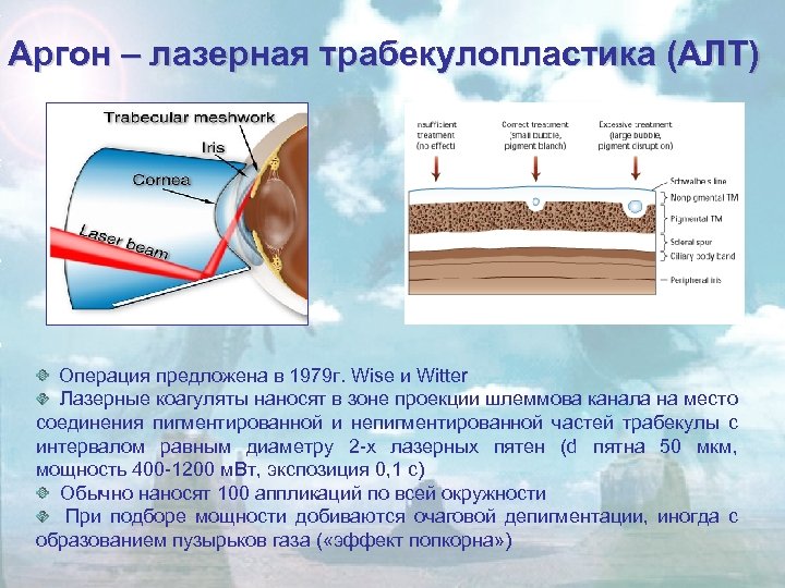 Аргон – лазерная трабекулопластика (АЛТ) Операция предложена в 1979 г. Wise и Witter Лазерные