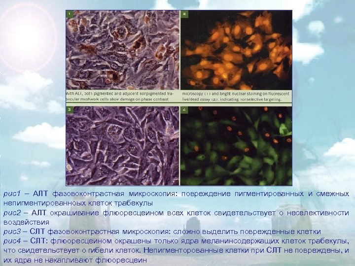 рис1 – АЛТ фазовоконтрастная микроскопия: повреждение пигментированных и смежных непигментированноых клеток трабекулы рис2 –