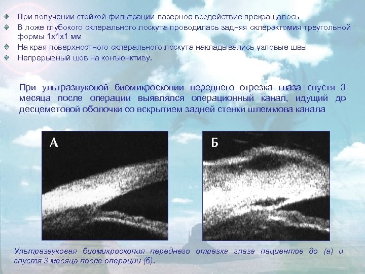 При получении стойкой фильтрации лазерное воздействие прекращалось В ложе глубокого склерального лоскута проводилась задняя