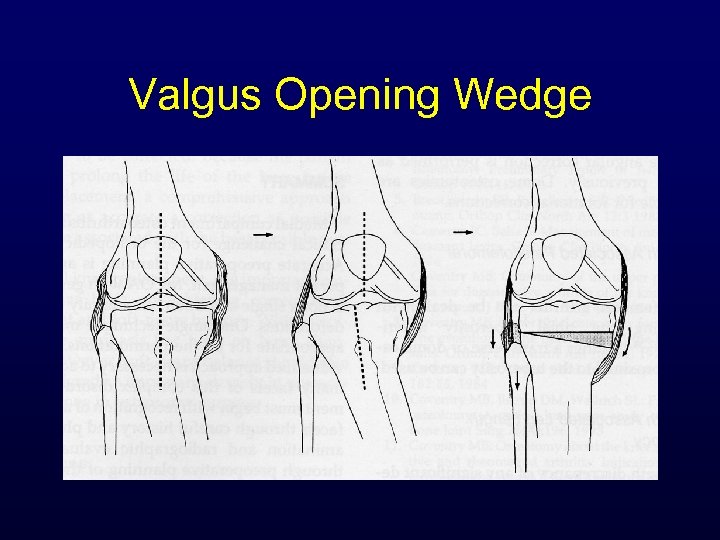 Valgus Opening Wedge 