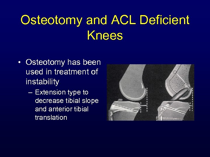 Osteotomy and ACL Deficient Knees • Osteotomy has been used in treatment of instability