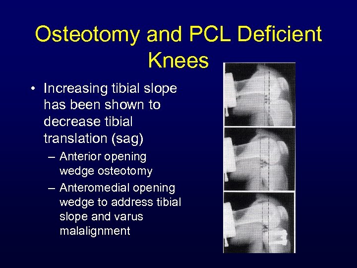 Osteotomy and PCL Deficient Knees • Increasing tibial slope has been shown to decrease