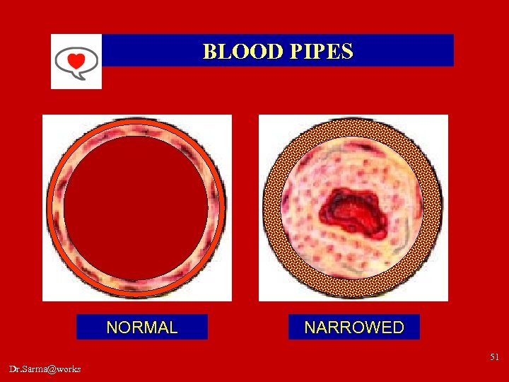 BLOOD PIPES NORMAL NARROWED 51 Dr. Sarma@works 