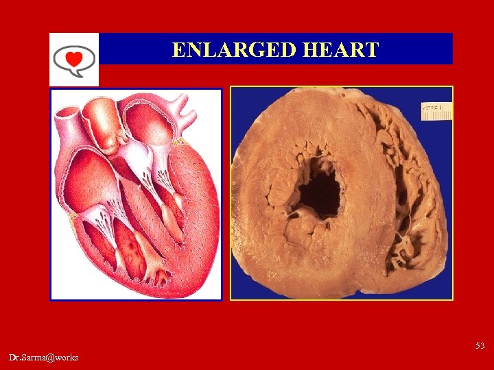 ENLARGED HEART 53 Dr. Sarma@works 