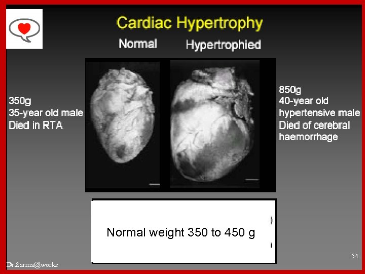 Normal weight 350 to 450 g 54 Dr. Sarma@works 