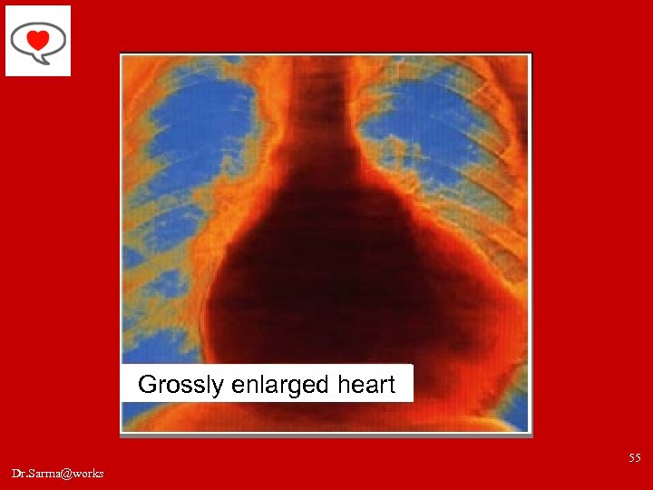 Grossly enlarged heart 55 Dr. Sarma@works 