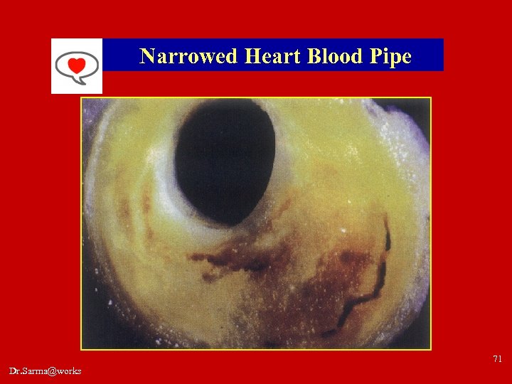Narrowed Heart Blood Pipe 71 Dr. Sarma@works 