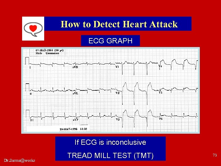 How to Detect Heart Attack ECG GRAPH If ECG is inconclusive Dr. Sarma@works TREAD