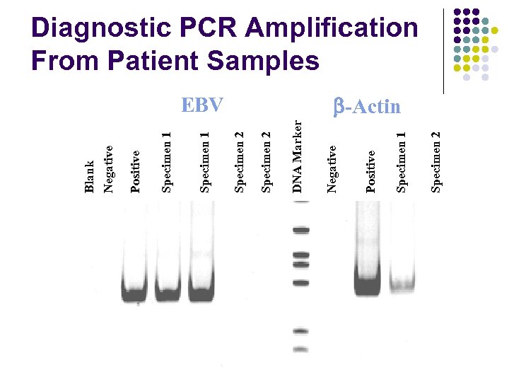 Specimen 2 Specimen 1 Positive EBV Negative DNA Marker Specimen 2 Specimen 1 Positive