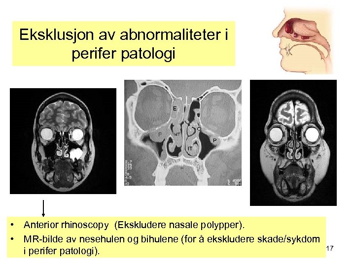 Eksklusjon av abnormaliteter i perifer patologi • Anterior rhinoscopy (Ekskludere nasale polypper). • MR-bilde