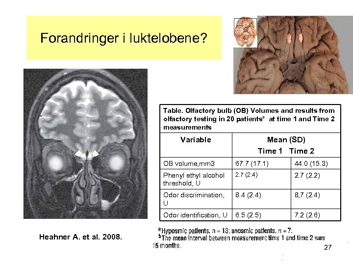 Forandringer i luktelobene? Table. Olfactory bulb (OB) Volumes and results from olfactory testing in