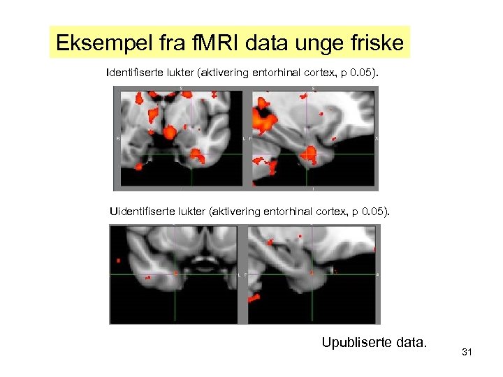 Eksempel fra f. MRI data unge friske Identifiserte lukter (aktivering entorhinal cortex, p 0.