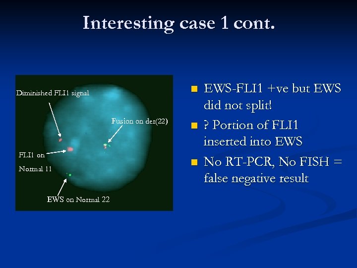 Interesting case 1 cont. n Diminished FLI 1 signal Fusion on der(22) FLI 1