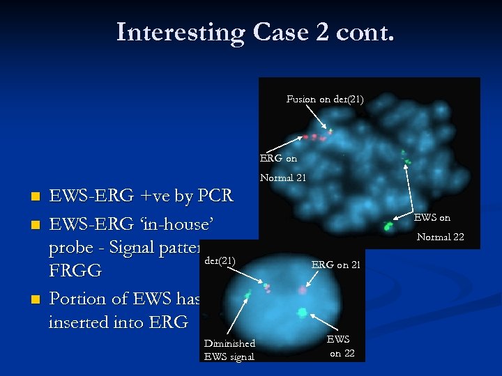 Interesting Case 2 cont. Fusion on der(21) ERG on Normal 21 n n n