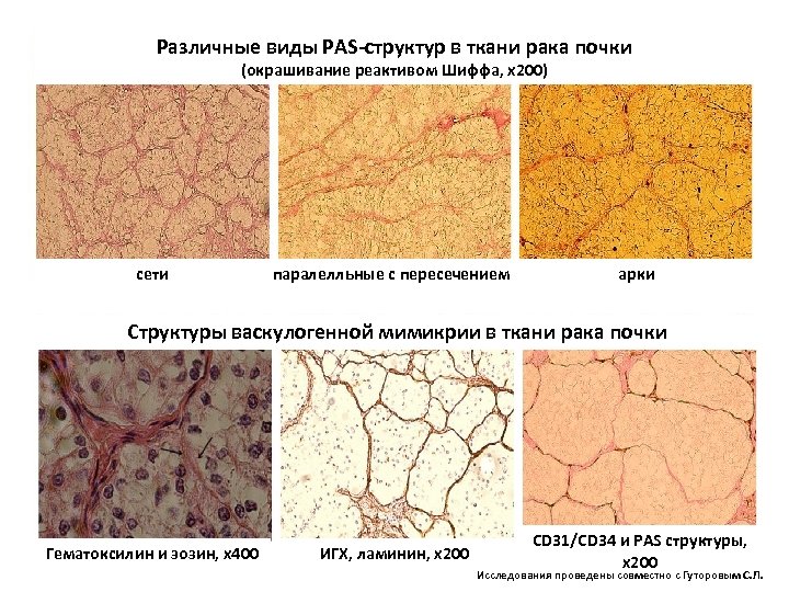 Различные виды PAS-структур в ткани рака почки (окрашивание реактивом Шиффа, х200) сети паралелльные с