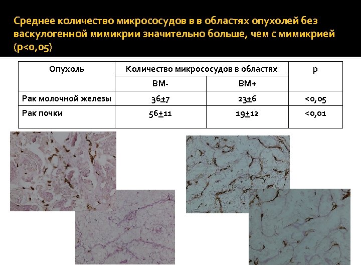 Среднее количество микрососудов в в областях опухолей без васкулогенной мимикрии значительно больше, чем с