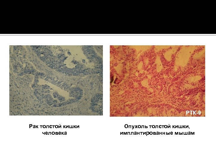 РТК-9 Рак толстой кишки человека Опухоль толстой кишки, имплантированные мышам 