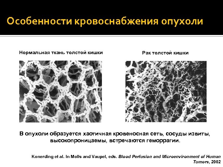 Особенности кровоснабжения опухоли Нормальная ткань толстой кишки Рак толстой кишки В опухоли образуется хаотичная