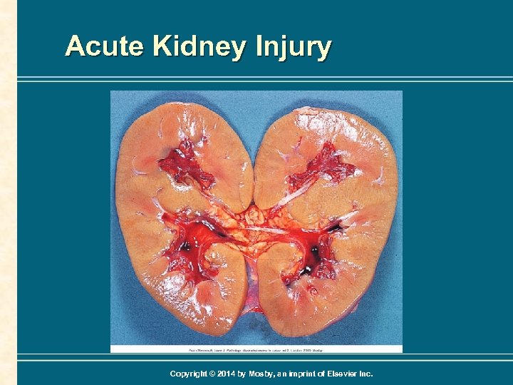 dissertation in acute kidney injury
