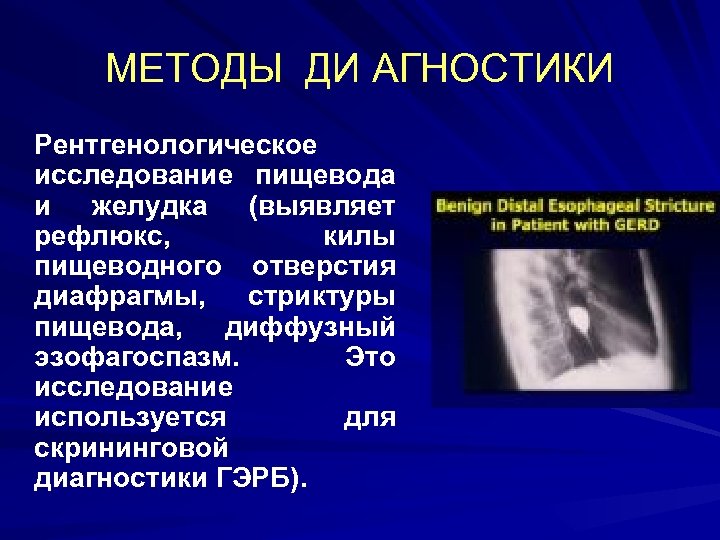 МЕТОДЫ ДИ АГНОСТИКИ Рентгенологическое исследование пищевода и желудка (выявляет рефлюкс, килы пищеводного отверстия диафрагмы,