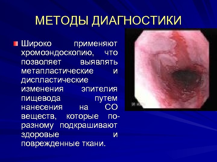 МЕТОДЫ ДИАГНОСТИКИ Широко применяют хромоэндоскопию, что позволяет выявлять метапластические и диспластические изменения эпителия пищевода