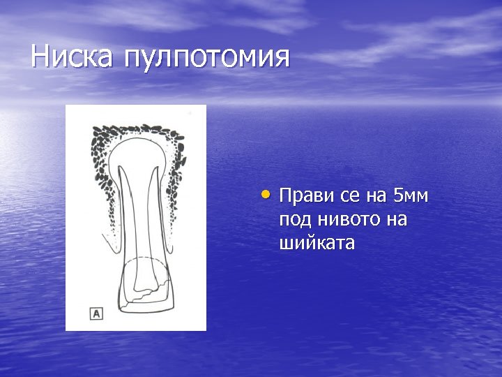 Ниска пулпотомия • Прави се на 5 мм под нивото на шийката 