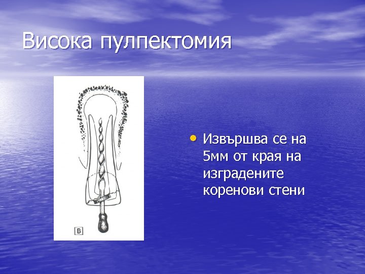 Висока пулпектомия • Извършва се на 5 мм от края на изградените коренови стени