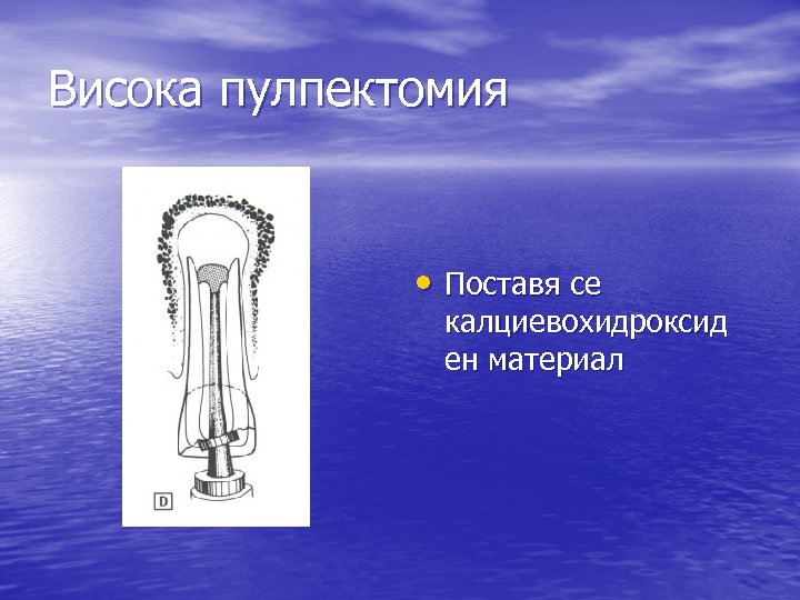 Висока пулпектомия • Поставя се калциевохидроксид ен материал 