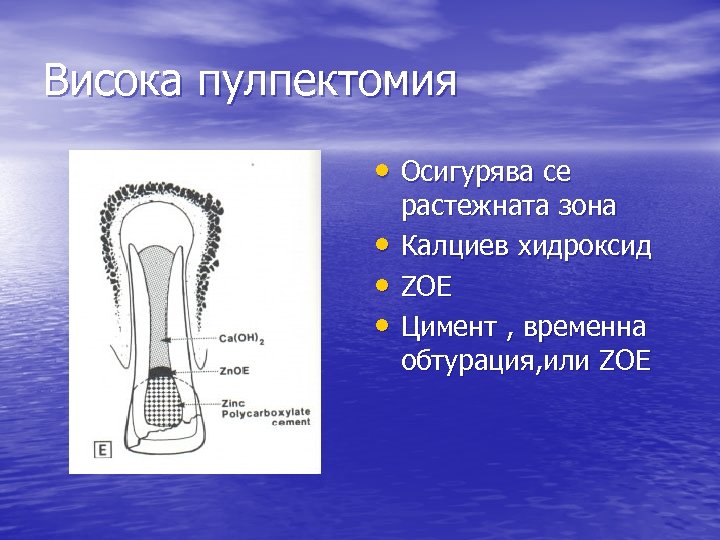 Висока пулпектомия • Осигурява се • • • растежната зона Калциев хидроксид ZOE Цимент