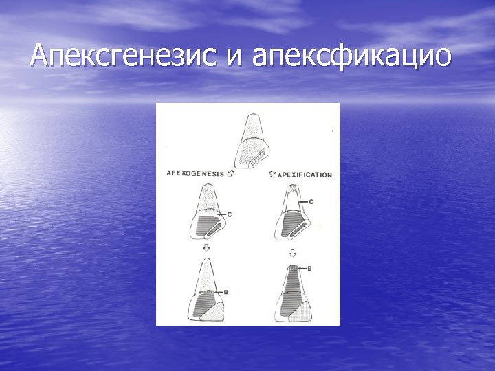 Апексгенезис и апексфикацио 