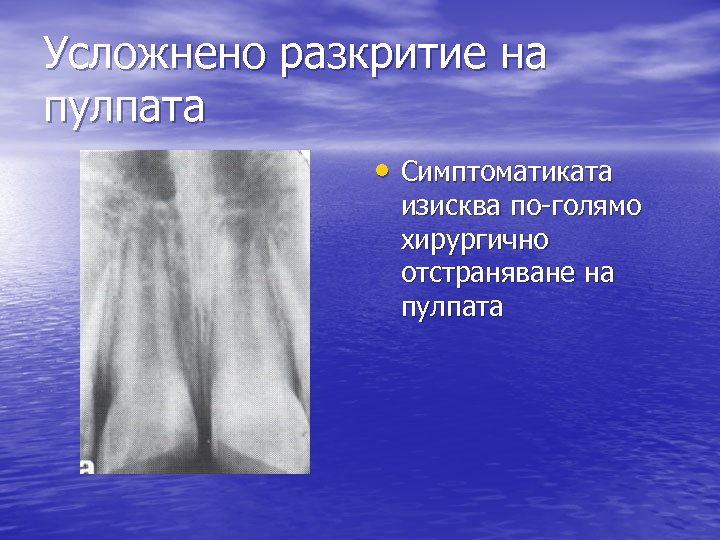 Усложнено разкритие на пулпата • Симптоматиката изисква по-голямо хирургично отстраняване на пулпата 