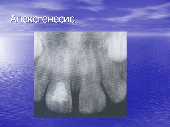 Апексгенесис 