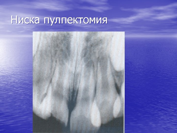 Ниска пулпектомия 